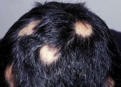 ریزش موی سکه ای از تشخیص تا درمان