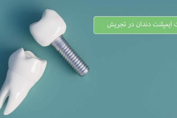 قیمت ایمپلنت دندان در تجریش