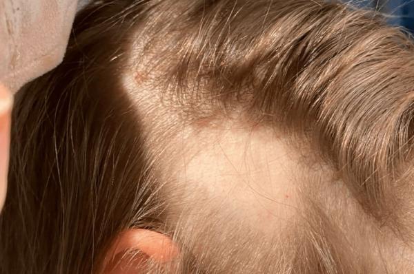 تایید نخستین دارو برای رشد دوباره موی نوجوانان دچار طاسی منطقه ای شدید